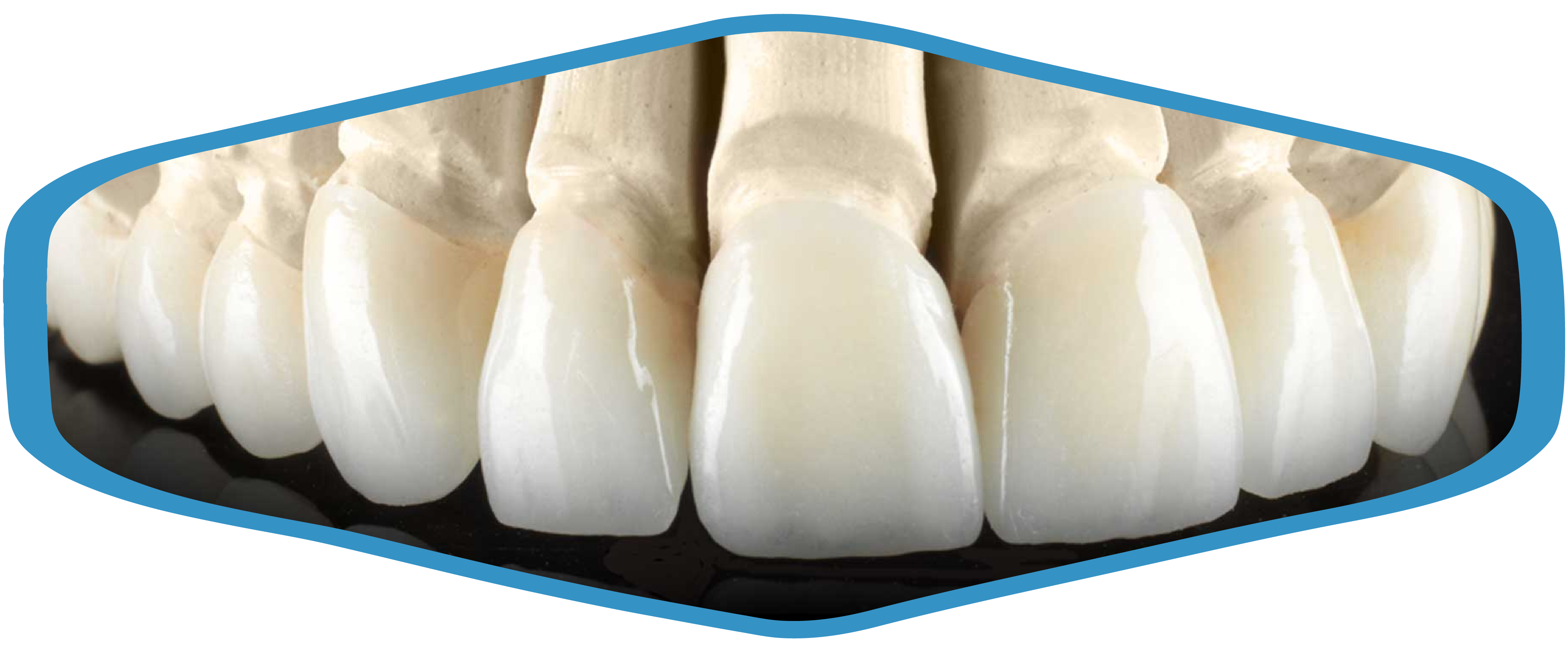complete-denture-set-crowns-with-ips-e.max-outlays-inlays