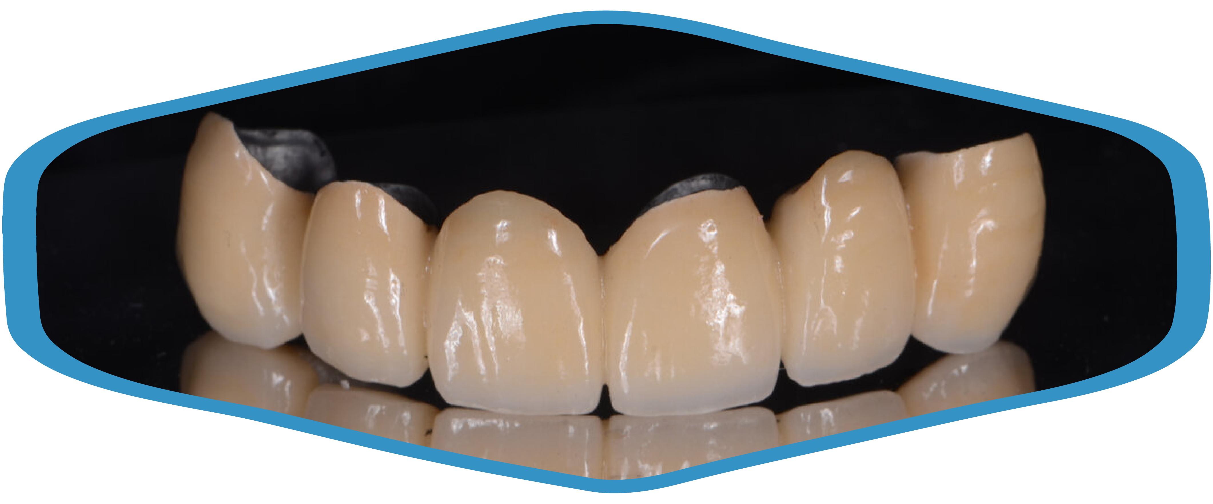 porcelain-crown-of-frontal-upper-denture-with-metal-fusion