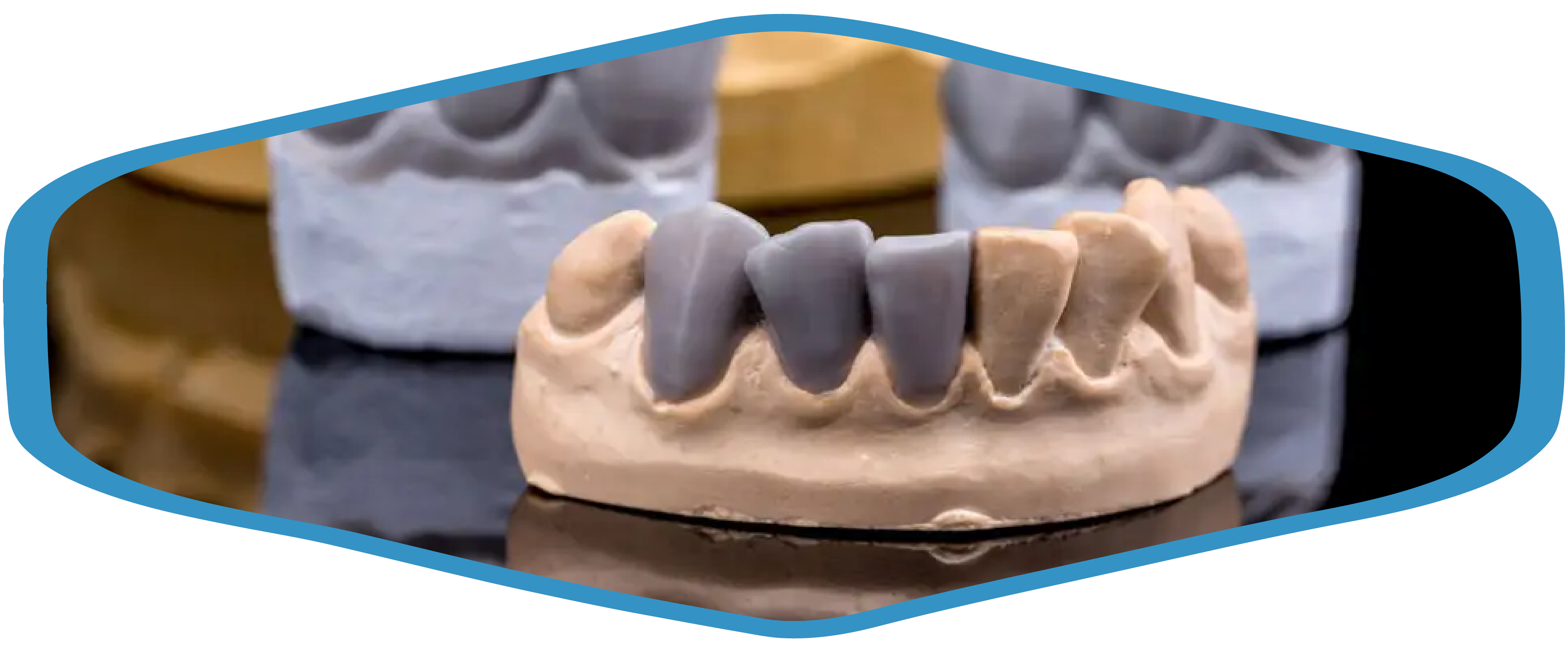 temporaries-wax-up-at-three-missing-tooth-at-lower-dental-arch